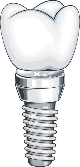 Dental Implant Illustration